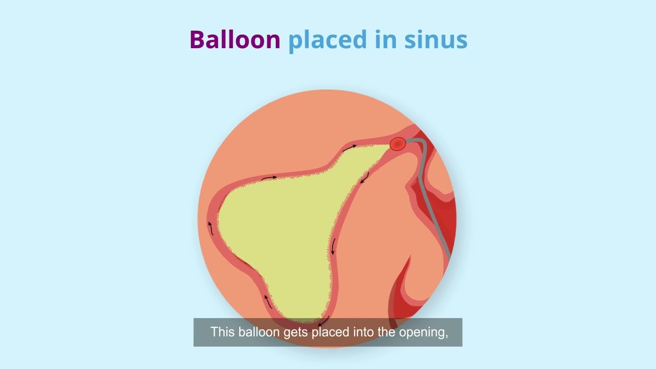 Balloon sinus dilation animation