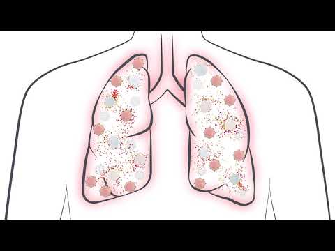 See how a Cytokine Storm can impact COVID-19 patients;  What do IL-6 levels tell you?