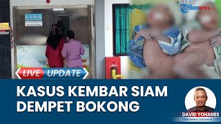 RSUD dr Iskak Tangani Bayi Kembar Siam Dempet Bokong: Kasus Langka, 1 Banding  250.000 Lahir Hidup