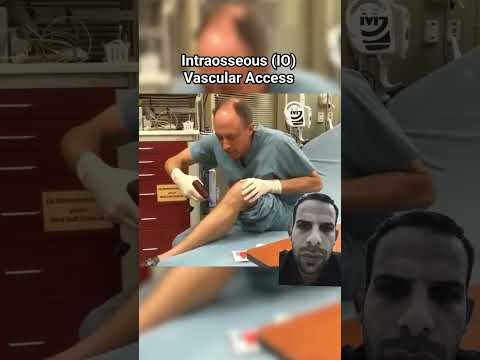 Intraosseous (IO) access