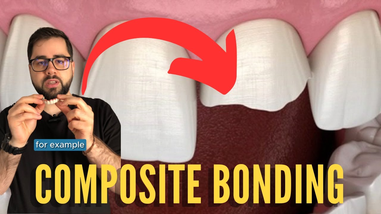 Composite Bonding | Dental Treatment | MJB CARE