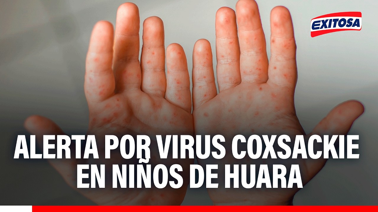🔴🔵 Se confirmaron casos del virus "boca, mano y pie" en menores