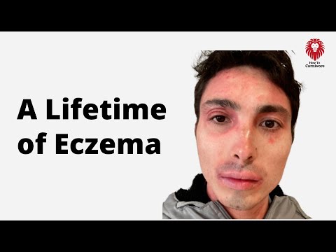 Can the Carnivore Diet Cure Severe Eczema? Bradley Marshall's Story.