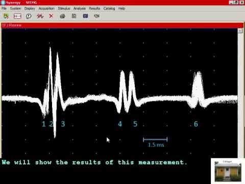SFEMG - Multi Spike Jitter Analysis  (Erik Stalberg)