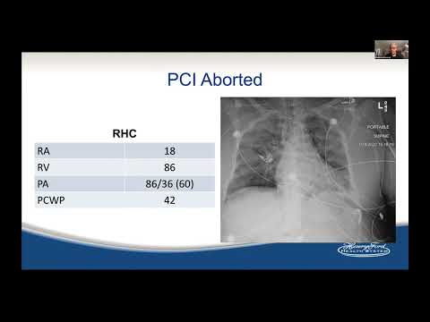 Hemodynamic Support for PCI: When and How?