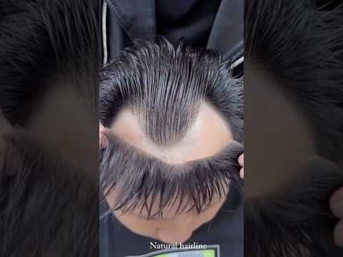 #Frontline hair patch for men’s#hair patch centre in Kolkata#best salon in Kolkata #human hair patch