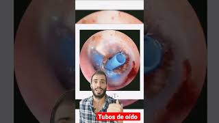 👂➡️Se ACABÓ el moco en el oído. Tubos de ventilación o drenajes transtimpánicos ✅