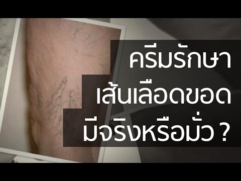 Triphala ในโรคสะเก็ดเงิน กาแฟสำเร็จรูปและโรคสะเก็ดเงิน