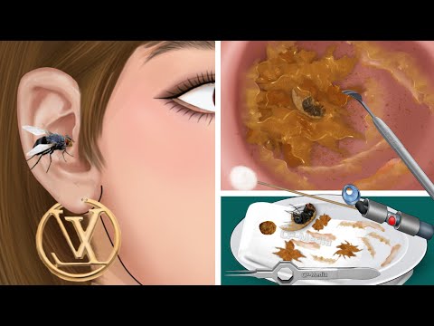ASMR The best treatment and remove flies and slimes in girls' ears | 실감나는 케어 애니메이션 2023