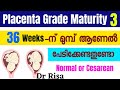 Placenta Grade Maturity 3 | Low Lying Placenta | Placenta Previa
