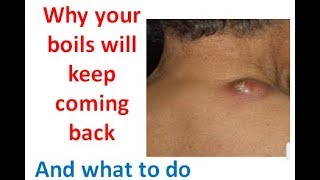 Boils keep coming back? here are what causes recurring boils & how to get rid of it permanently