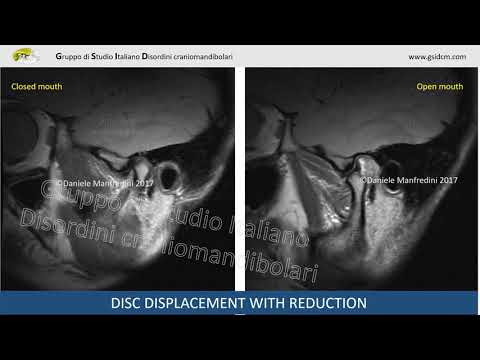 Tazze nel trattamento dei giunti Sintomi osteocondrosi toraciche di ICD 10