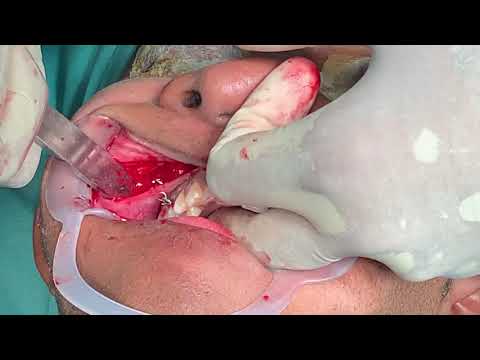 Pterygomaxillary Dysfunction