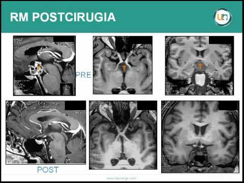 tratamiento de un craneofaringioma