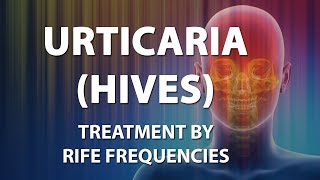 Urticaria (Hives) - RIFE Frequencies Treatment - Energy &amp; Quantum Medicine with Bioresonance