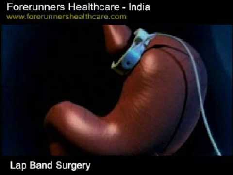 weight loss: Lap-band surgery in India