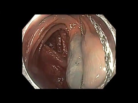 Colonoscopy: Snare Tip Cautery to Anchor for En-Bloc Resection