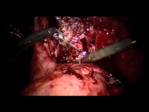 Extracción robótica de miomas uterinos con dos brazos adicionales