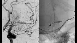 (English) Acute high grade MCA stenosis PTA and Stenting