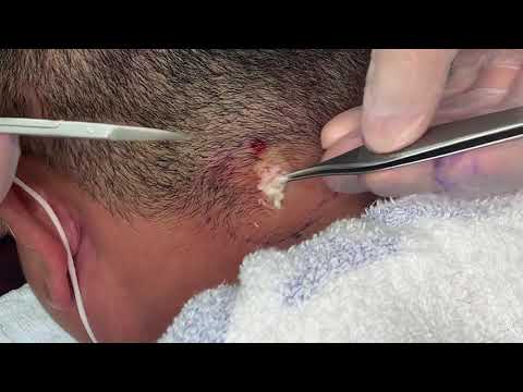 Epidermal Cyst Atheroma Cystic Acne Extractions Lipoma 2026