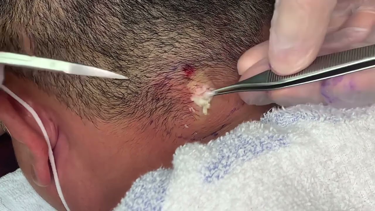 粉瘤くりぬき法　40代男性首epidermal cyst atheroma cystic acne extractions lipoma大阪心斎橋　大阪梅田院　名古屋　福岡院　神戸西宮　尼崎　奈良