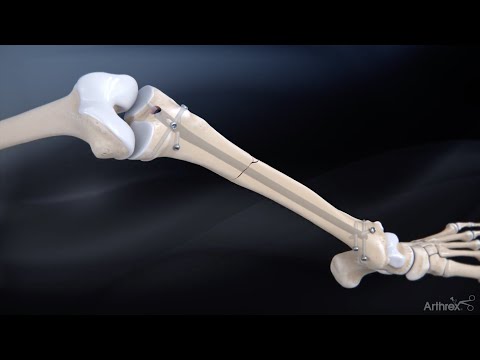 Tibia Fractures Tnadvanced Tibial Nailing System