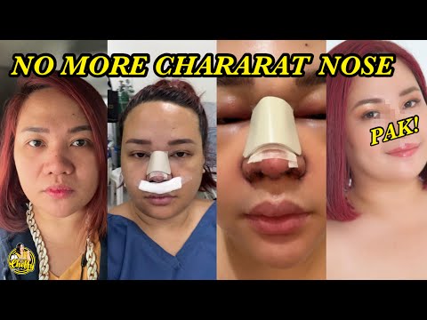 MY RHINOPLASTY JOURNEY (FULL VIDEO)