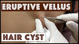 Unusual types of Cysts: Eruptive Vellus Hair Cysts, Part 1 in a Series