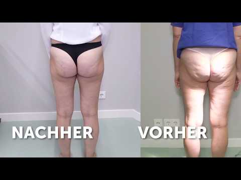 Rückenschmerzen in der Schwangerschaft 13 Wochen Magnet zervikale Osteochondrose