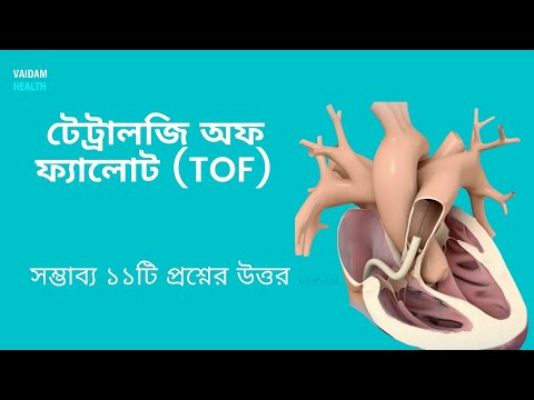 টেট্রালজি অফ ফ্যালোট - ১১ টি প্রায়শই জিজ্ঞাসিত প্রশ্ন