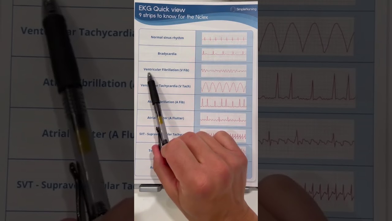 9 EKG Strips to know for the NCLEX!