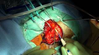 Resection of a cystic brainstem hemangioblastoma via a retrosigmoid approach