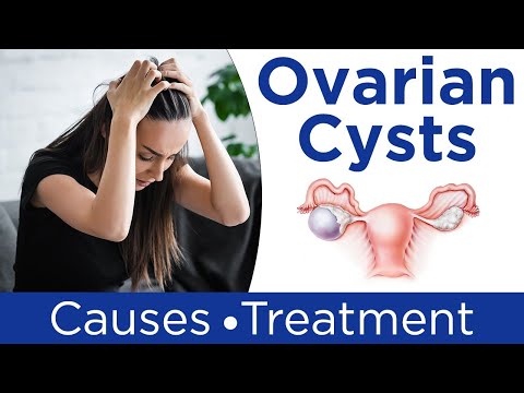 Ovarian Cyst: Causes, Symptoms and Treatment
