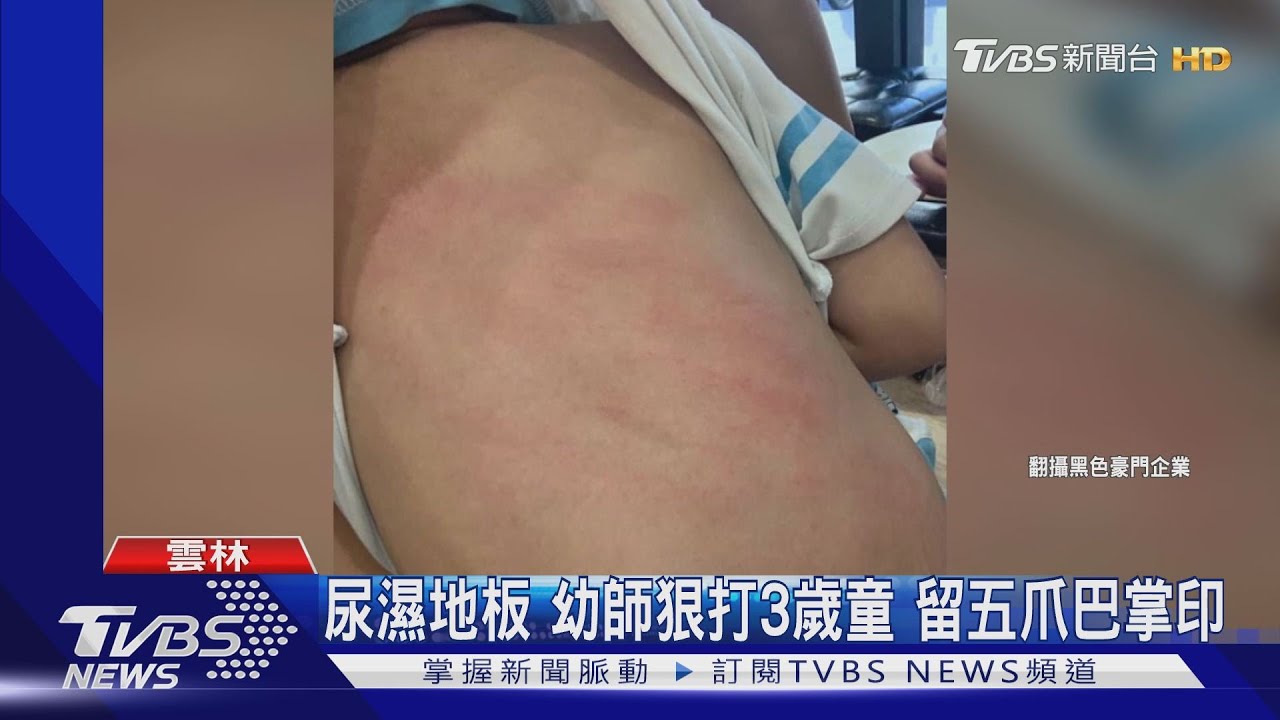 尿濕地板幼師狠打3歲童 留五爪巴掌印