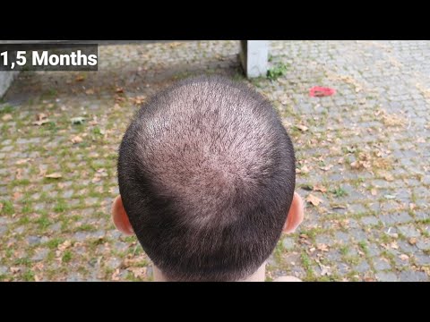 FUE Hair Transplant Timeline I Day 1 to Day 365 I...