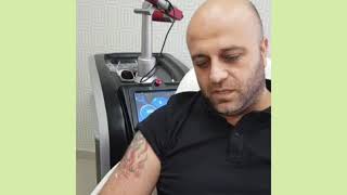 #dövmesilme #pikosaniye #pico #Sure #ozdemirlazermedikal  Kesinlikle izle Dövme 
