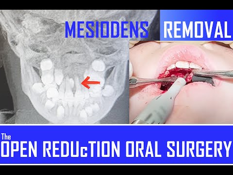 Mesiodens Removal - The Complete Workup & Surgery