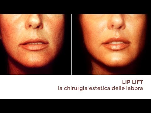 2° PUNTATA: Labbra, fillers e chirurgia | Studio del Dottor Santanchè - Chirurgia estetica, Medicina estetica