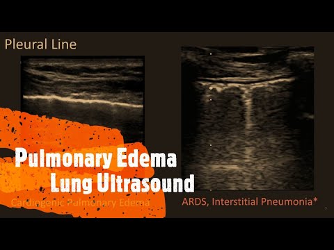 Pulmonary Edema on Lung Ultrasound. Perioperative & Critical Care POCUS