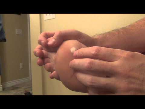 wart right foot icd 10