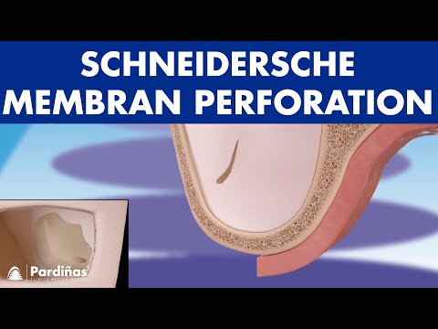 Schneidersche membran – Perforation und Wiederherstellung  ©