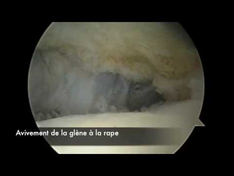 comment traiter une luxation de l'epaule