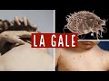 LA GALE ( SYMPTOMES , CAUSE , DIANOSTIC ET TRAITEMENT )