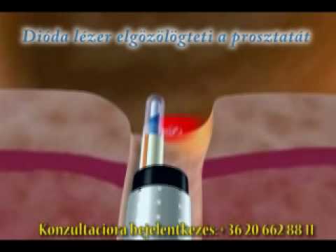 A Zozh- i prosztatitis recept kezelése