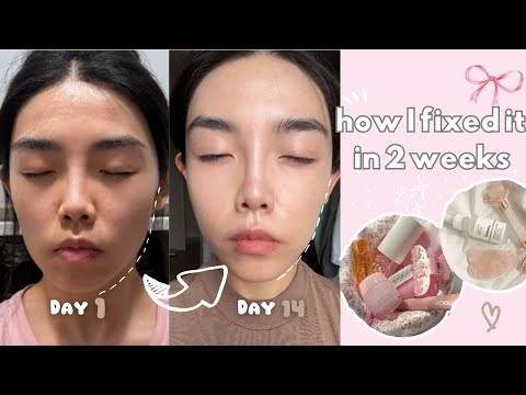 I Fixed My Asymmetrical Face in 2 Weeks
