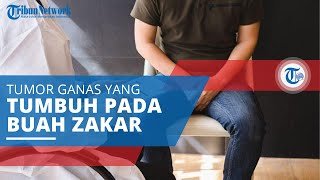 Kanker Testis, Tumor Ganas di Organ Vital Pria yang Tumbuh di Area Buah Zakar