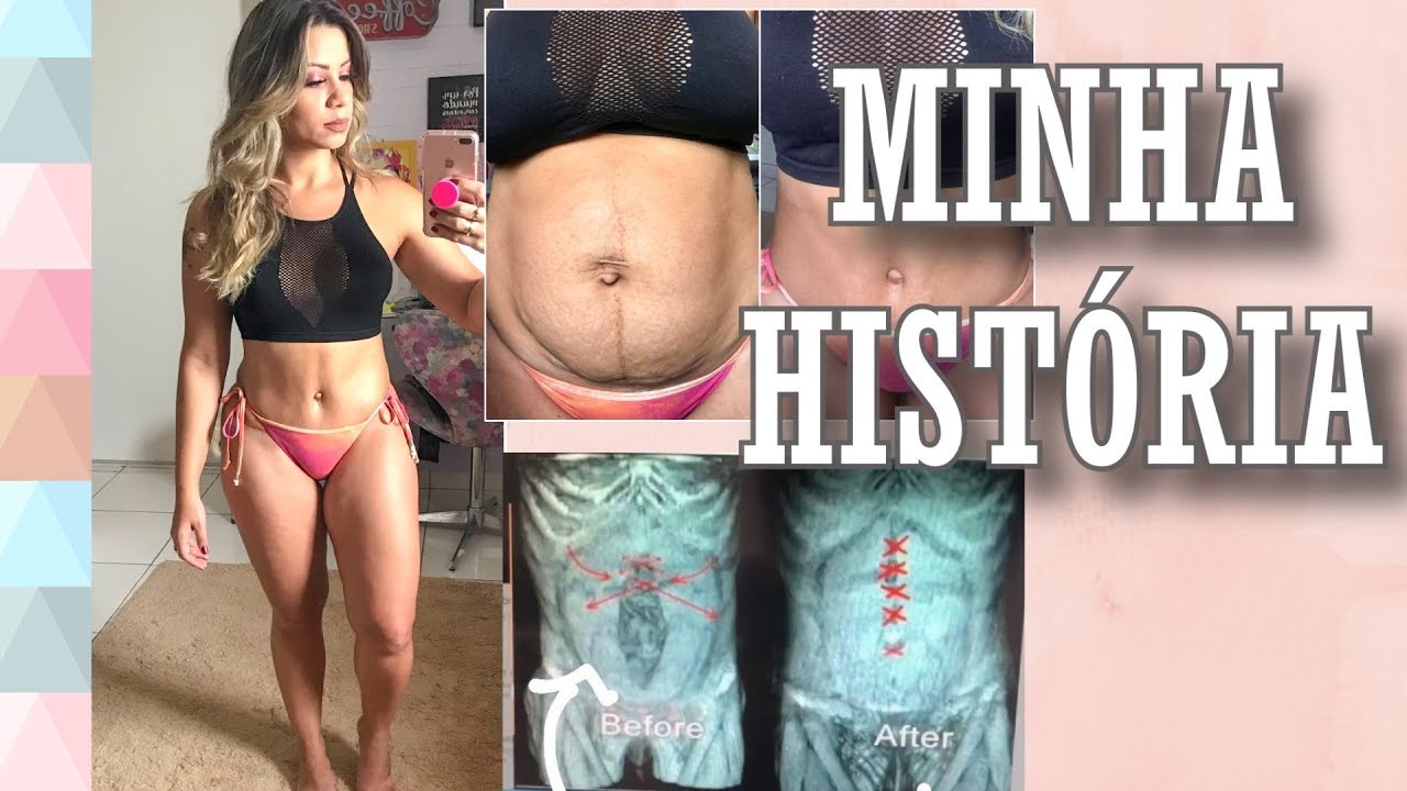 ABDOMINOPLASTIA + MASTOPEXIA COM PRÓTESES: RECUPERAÇÃO, VALORES $, RESULTADOS E MAIS...