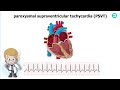 Types and ECG features of Supraventricular Tachycardia (SVT)