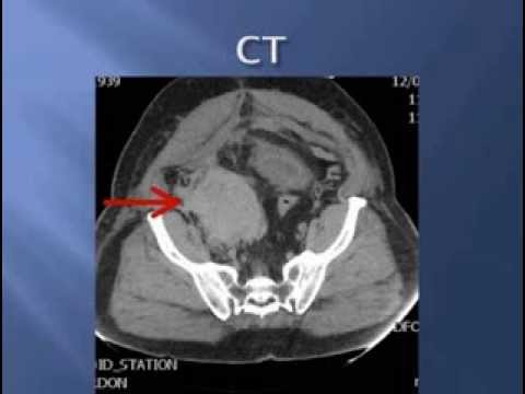 A Novel Approach to the Management of Retroperitoneal Hemorrhage