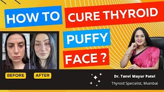 How to cure Thyroid Puffy Face ? by Dr Tanvi Mayur Patel